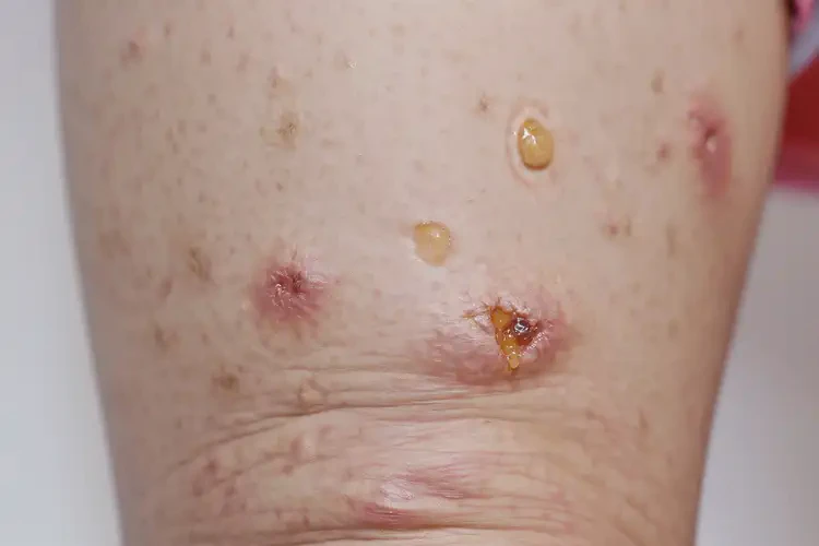 幼兒大腿上起濕疹能徹底自愈嗎(圖3)