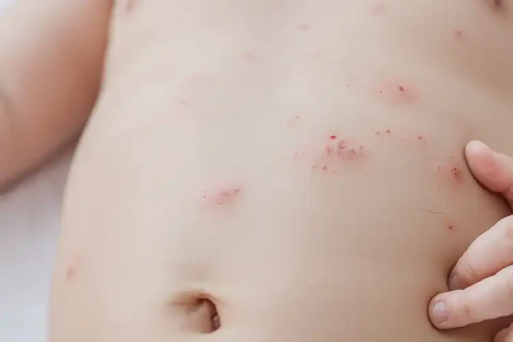 寶寶肚子偶爾長濕疹不管它會自己痊愈嗎(圖4)