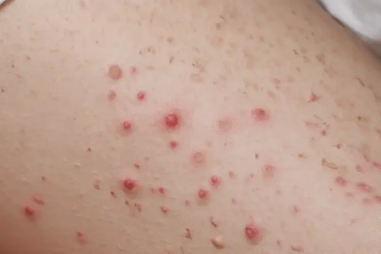 孕婦小腿偶爾起濕疹可不可以徹底自愈(圖4)