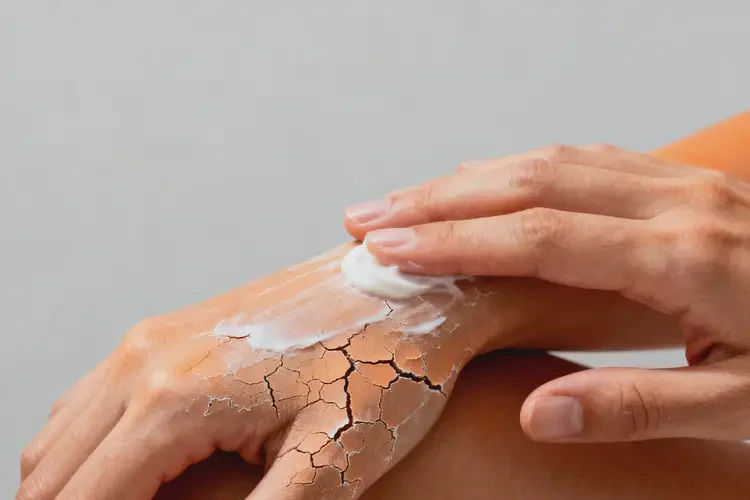 女性全身出湿疹能彻底自愈吗(图4)