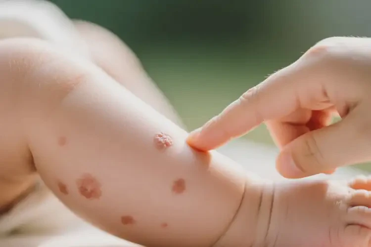 宝宝小腿偶尔起湿疹不管它会自己自愈吗(图2)