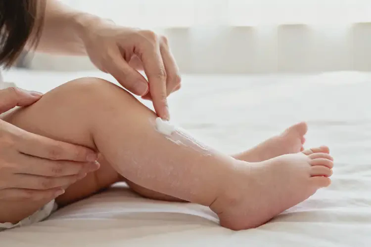 嬰兒小腿上容易起濕疹能夠徹底治愈嗎(圖4)