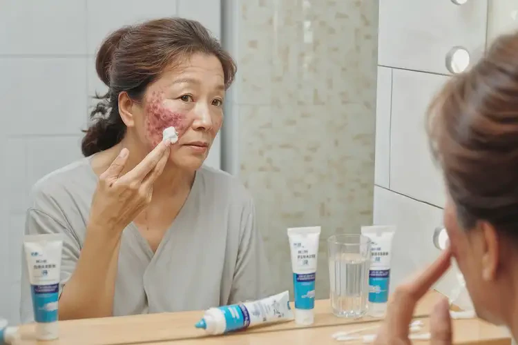 女人脸上经常长湿疹不管它会自己自愈吗(图1)