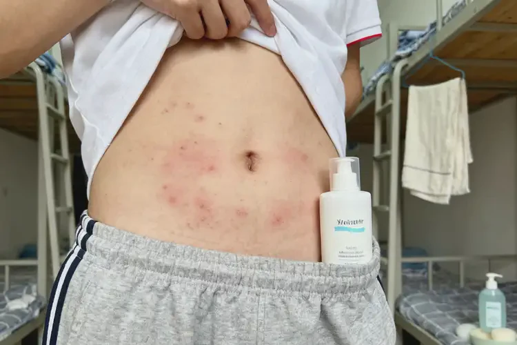 大學生肚子出濕疹能不能徹底自愈(圖4)
