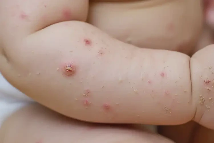 幼兒全身起濕疹可以徹底自愈嗎(圖4)