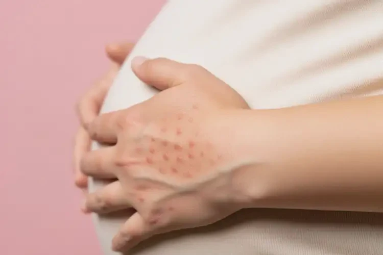 孕婦手上出濕疹不管它會自己自愈嗎(圖2)