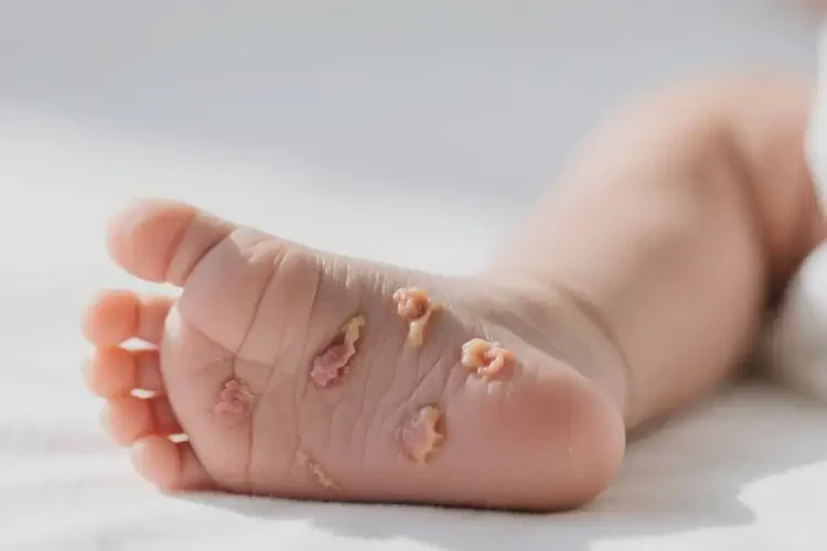 新生兒腳上有濕疹不管它會(huì)自己自愈嗎(圖3)