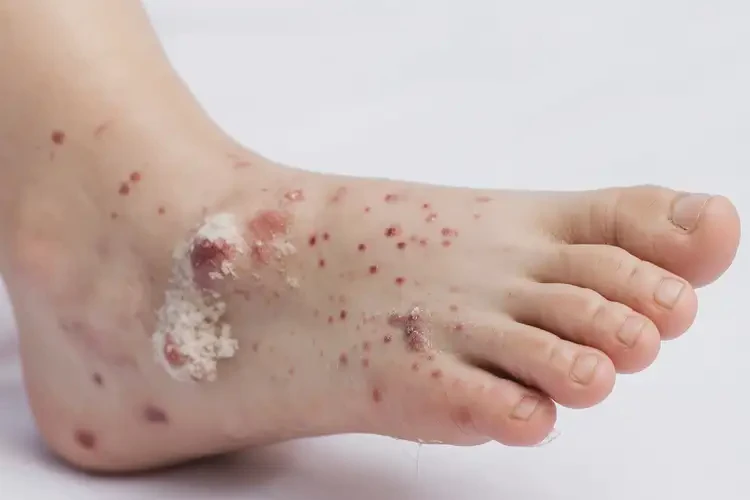 小兒腳上經(jīng)常起濕疹不管它會自己自愈嗎(圖4)