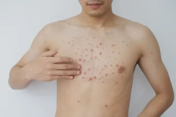 男生肚子上偶爾長濕疹能徹底自愈嗎(圖3)