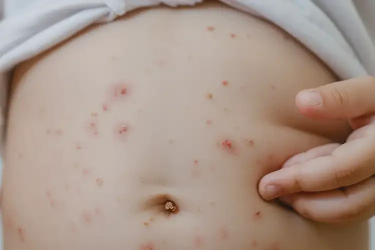 少兒肚子上出濕疹不管它會(huì)自己好嗎(圖4)