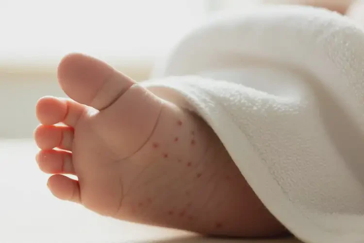 小兒身上偶爾長濕疹不管它會自己自愈嗎(圖3)