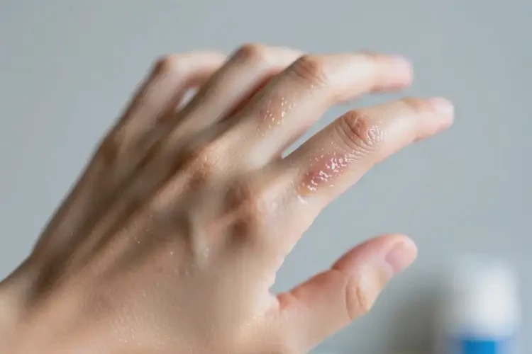 青少年手上出濕疹能徹底自愈嗎(圖1)