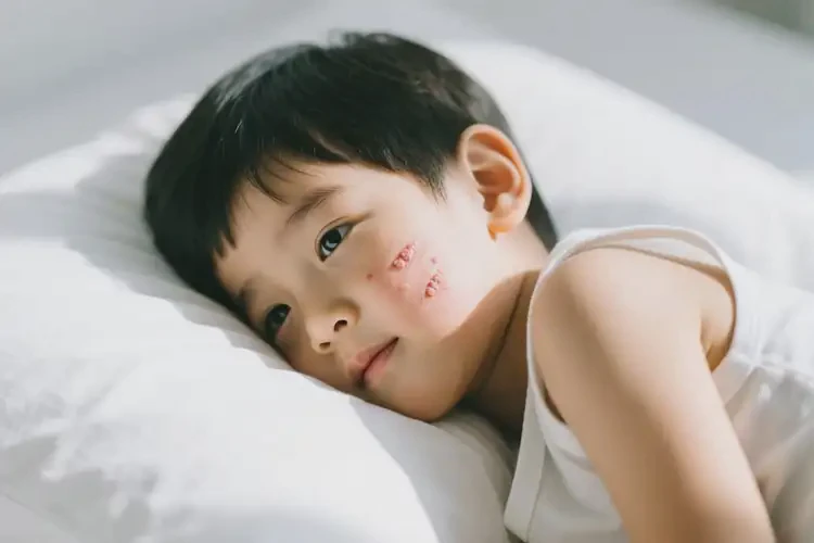 孩子面部经常起湿疹能靠自己自愈吗(图1)