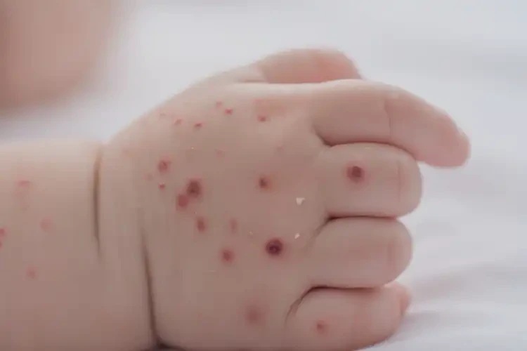 嬰幼兒手上偶爾起濕疹可以徹底自愈嗎(圖4)