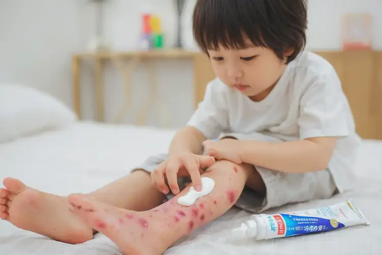 兒童小腿上起濕疹可不可以徹底自愈(圖3)