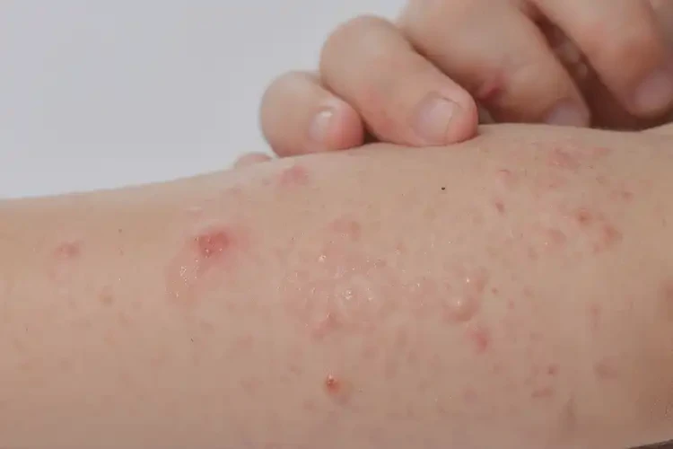 孩子手臂有濕疹可不可以徹底自愈(圖4)