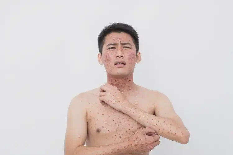 青年人全身有濕疹能徹底自愈嗎(圖4)