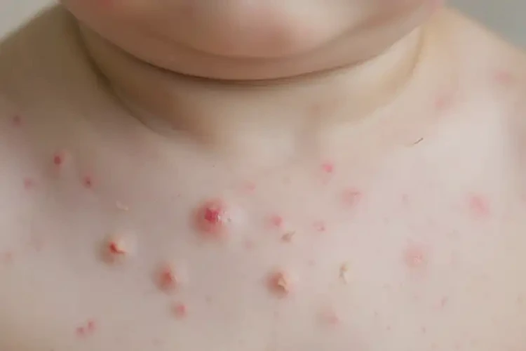 幼兒脖子出現(xiàn)濕疹不管它會(huì)自己好嗎(圖4)