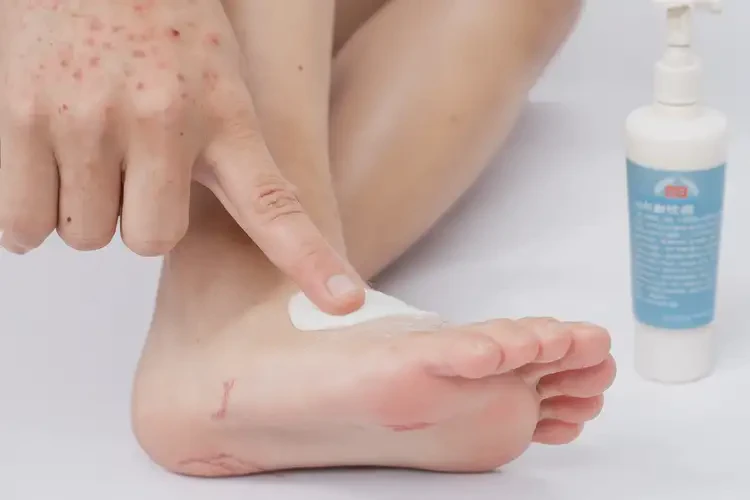 小孩腳上有濕疹可不可以徹底自愈(圖3)