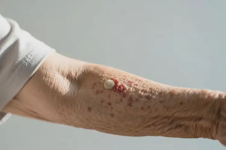 老人手臂長濕疹不管它會自己好嗎(圖4)