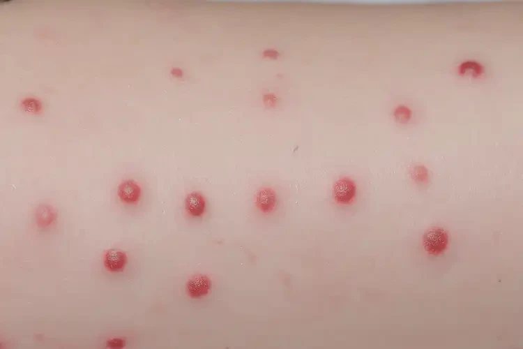 幼兒屁股上經(jīng)常起濕疹不管它會自己痊愈嗎(圖4)