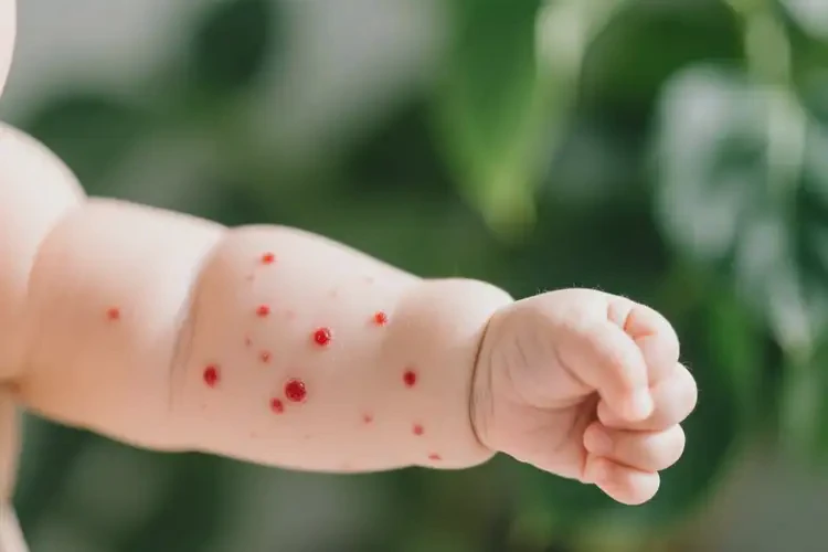 寶寶手臂經(jīng)常長(zhǎng)濕疹不管它會(huì)自己好嗎(圖2)