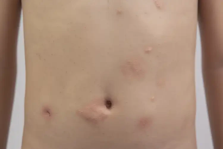 青少年肚子上出現(xiàn)濕疹可以徹底自愈嗎(圖4)