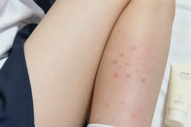 大學(xué)生小腿上容易起濕疹可不可以徹底自愈(圖3)