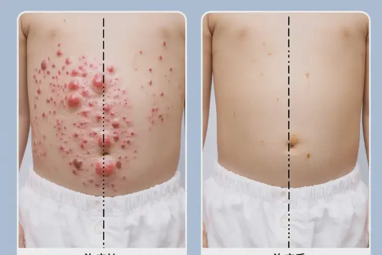 少兒肚子有濕疹不管它會自己自愈嗎(圖1)