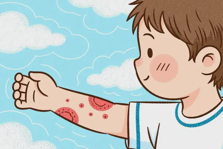 少兒手臂上長(zhǎng)濕疹可不可以徹底自愈(圖3)