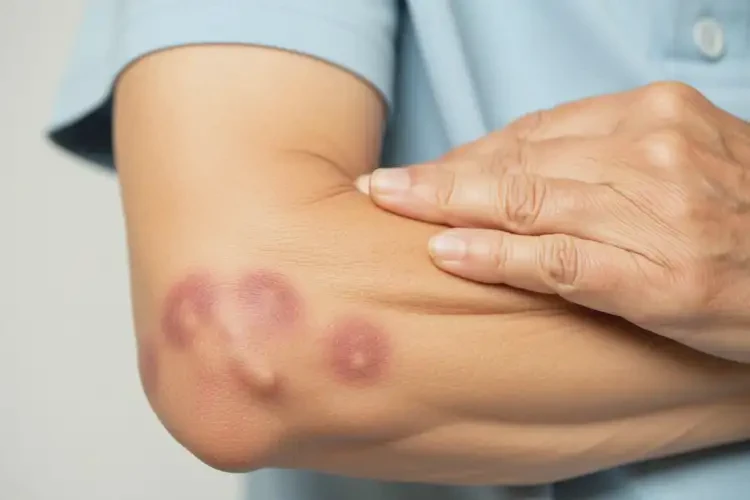 老人手臂起濕疹不管它會自己痊愈嗎(圖4)