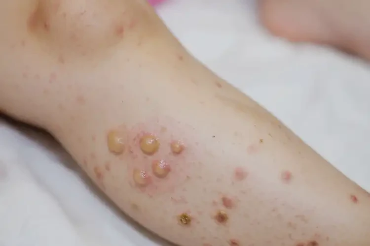 孩子小腿上偶爾長濕疹不管它會自己好嗎(圖3)