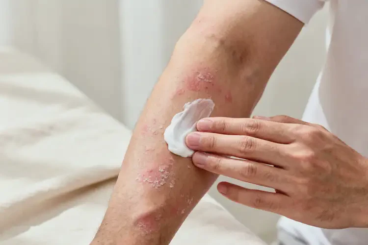 男人手臂上有湿疹能不能彻底自愈(图4)