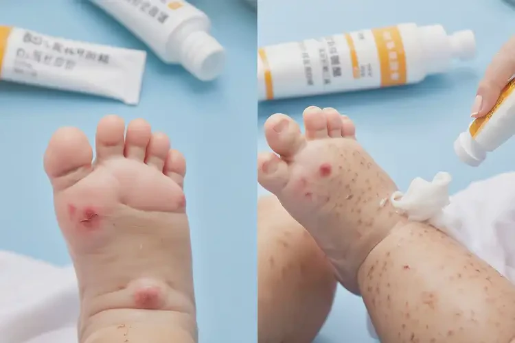 幼儿脚上有湿疹能彻底自愈吗(图3)