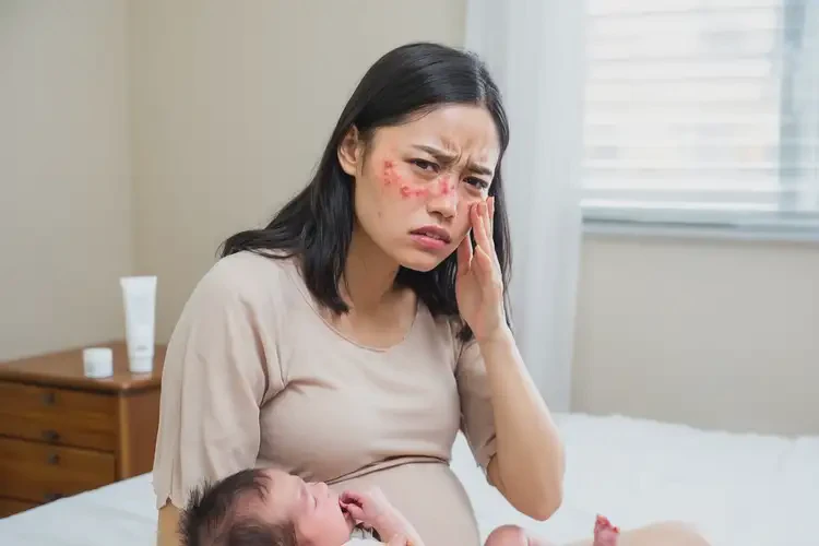 哺乳期媽媽面部長(zhǎng)濕疹能不能徹底自愈(圖4)