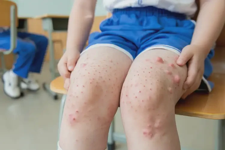 小學(xué)生大腿出濕疹不管它會(huì)自己自愈嗎(圖4)