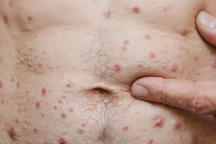 老年人肚子上有湿疹可以彻底自愈吗(图4)