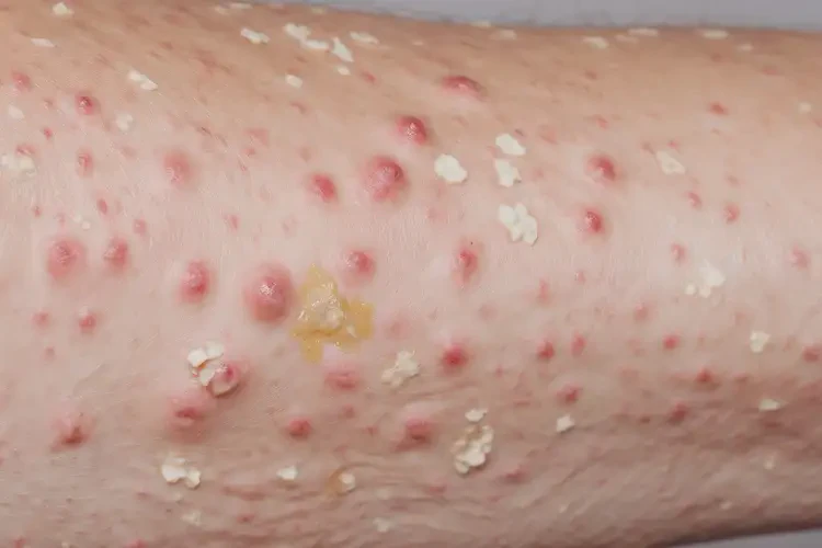 女生腳上起濕疹可不可以徹底自愈(圖3)