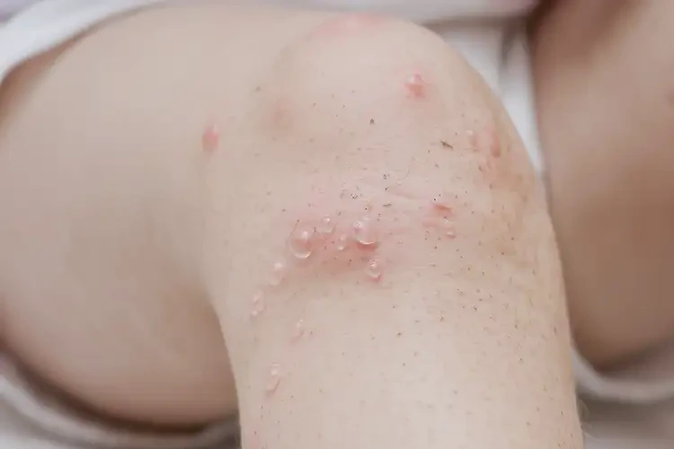 孩子大腿上偶爾起濕疹不管它會自己痊愈嗎(圖4)