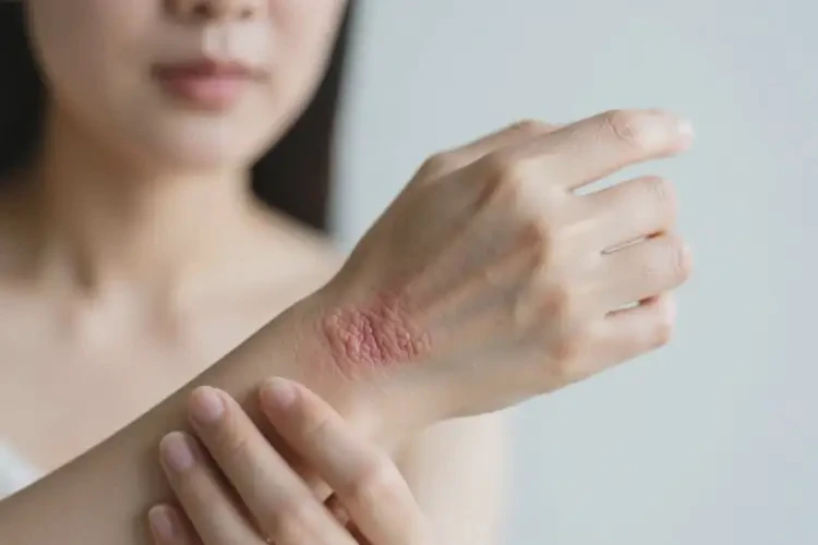 女性身上偶爾起濕疹不管它會自己痊愈嗎(圖3)