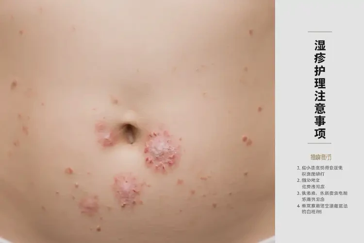 少兒肚子上長(zhǎng)濕疹可以徹底自愈嗎(圖4)