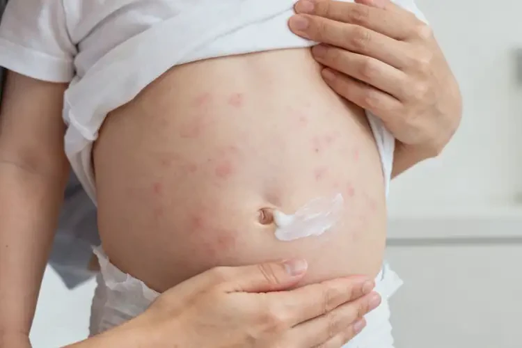 幼兒肚子長濕疹不管它會自己自愈嗎(圖1)