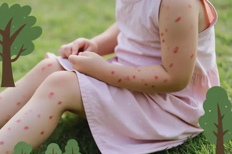 小學(xué)生全身偶爾起濕疹不管它會(huì)自己好嗎(圖3)