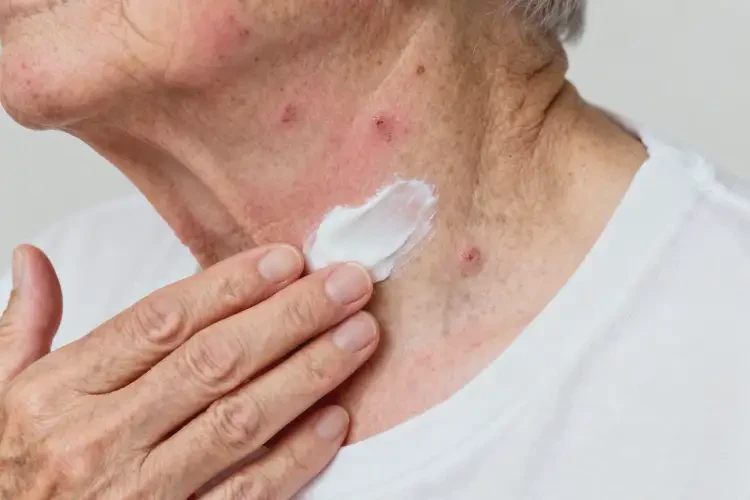 高齡老人脖子上長(zhǎng)濕疹能不能徹底自愈(圖2)