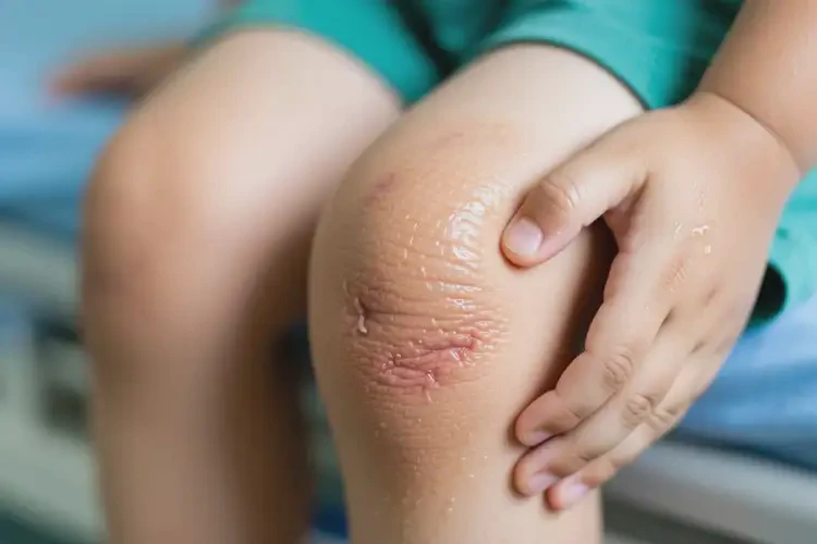 兒童四肢長濕疹可以徹底自愈嗎(圖2)