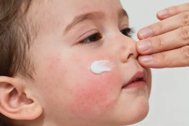 幼儿脸上有湿疹能彻底自愈吗(图4)