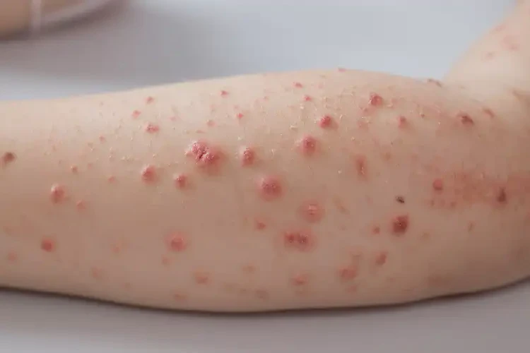 小學(xué)生手臂上有濕疹能夠徹底治愈嗎(圖4)