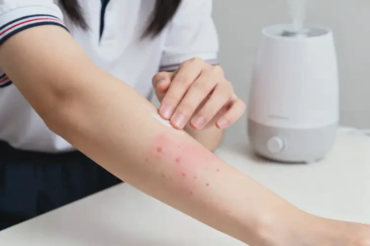 大學生手臂上容易起濕疹能不能徹底自愈(圖1)