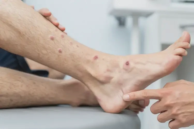 青年人腳上偶爾長濕疹不管它會自己好嗎(圖4)