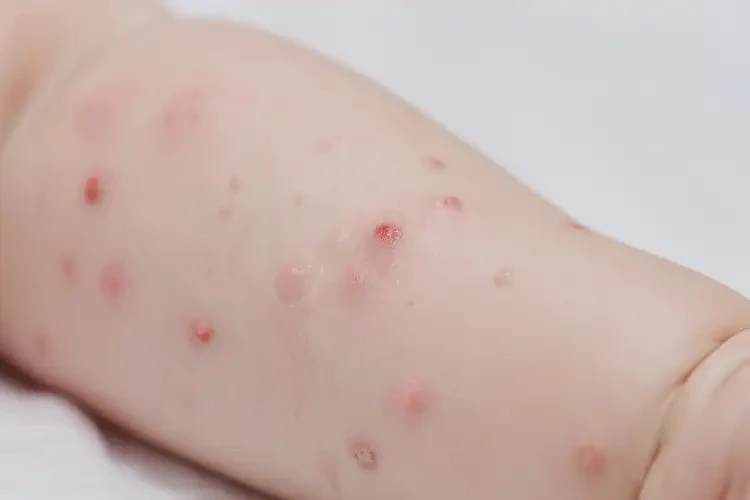 寶寶手臂上偶爾長濕疹可不可以徹底自愈(圖4)